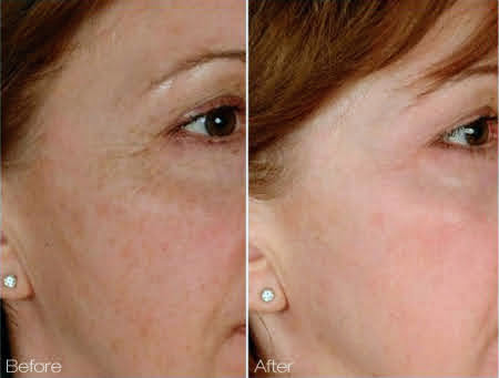 Laser-Treatment-Skin-Care-Cutera-Genesis